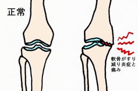 変形性膝関節症