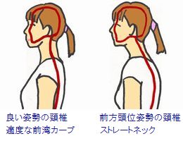 頚椎・椎間板による神経圧迫