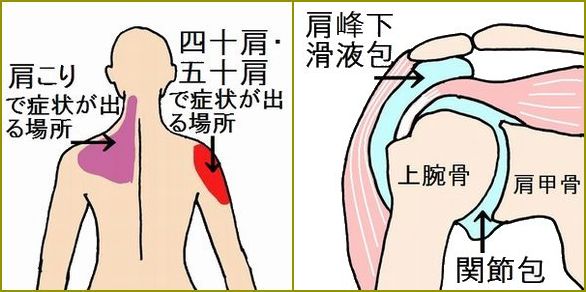 「肩こり」と四十肩・五十肩の違い