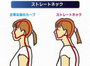 スマホ症候群とストレートネック